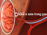 Siêu âm doppler mạch máu khối u gan